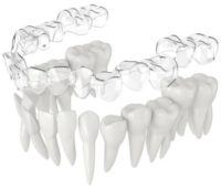 Alinhador dentário Alinhador dentário